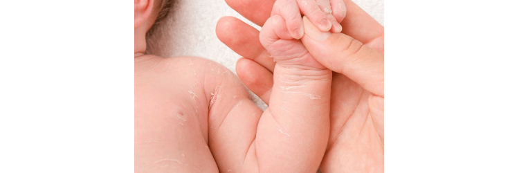 Bebek Cilt Bakımı: Pişik ve Konakla Mücadele